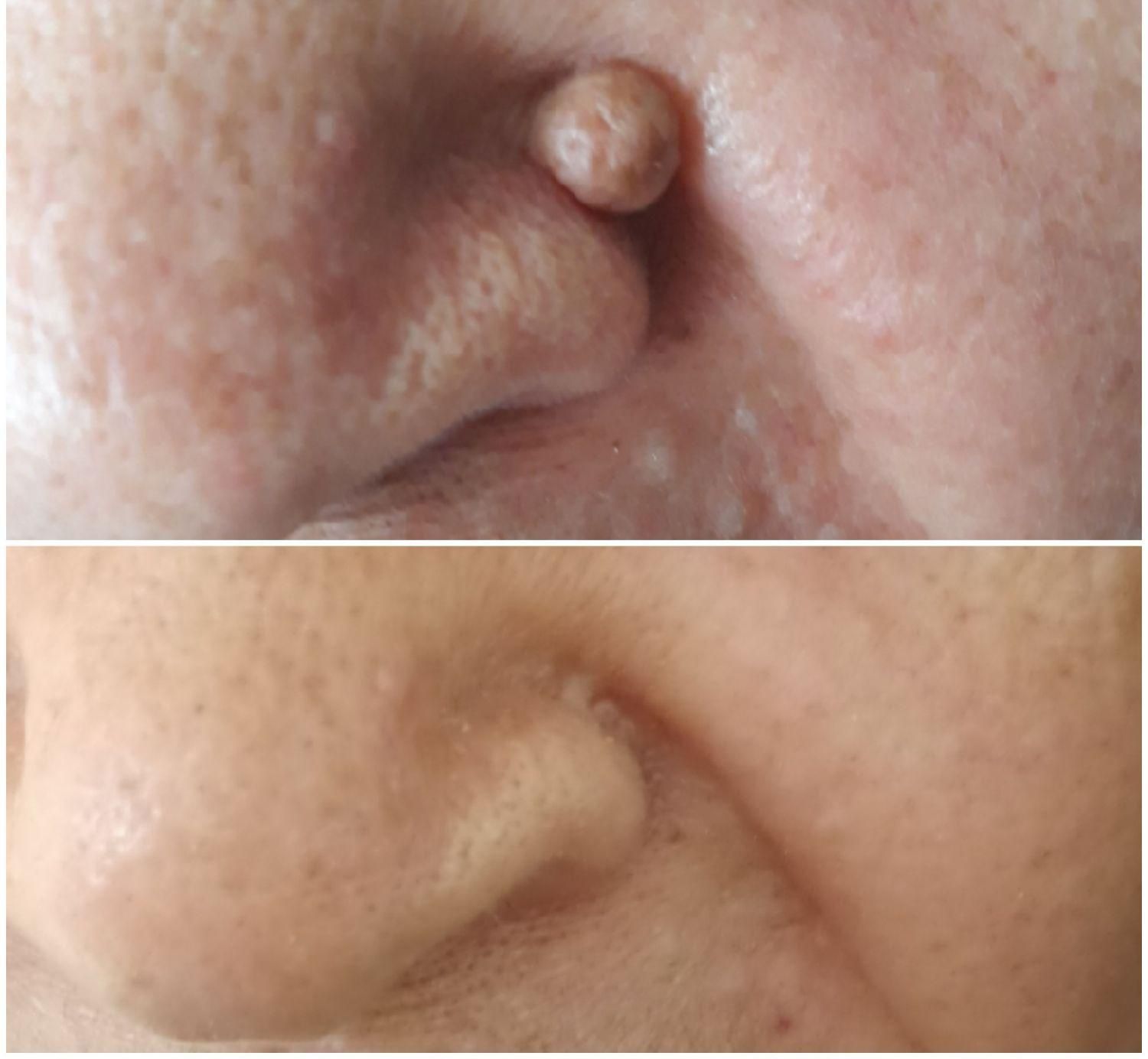 حذف خال ،میخچه ،زگیل فقط بامحلول گیاهی|خدمات آرایشگری و زیبایی|خمینیشهر, |دیوار