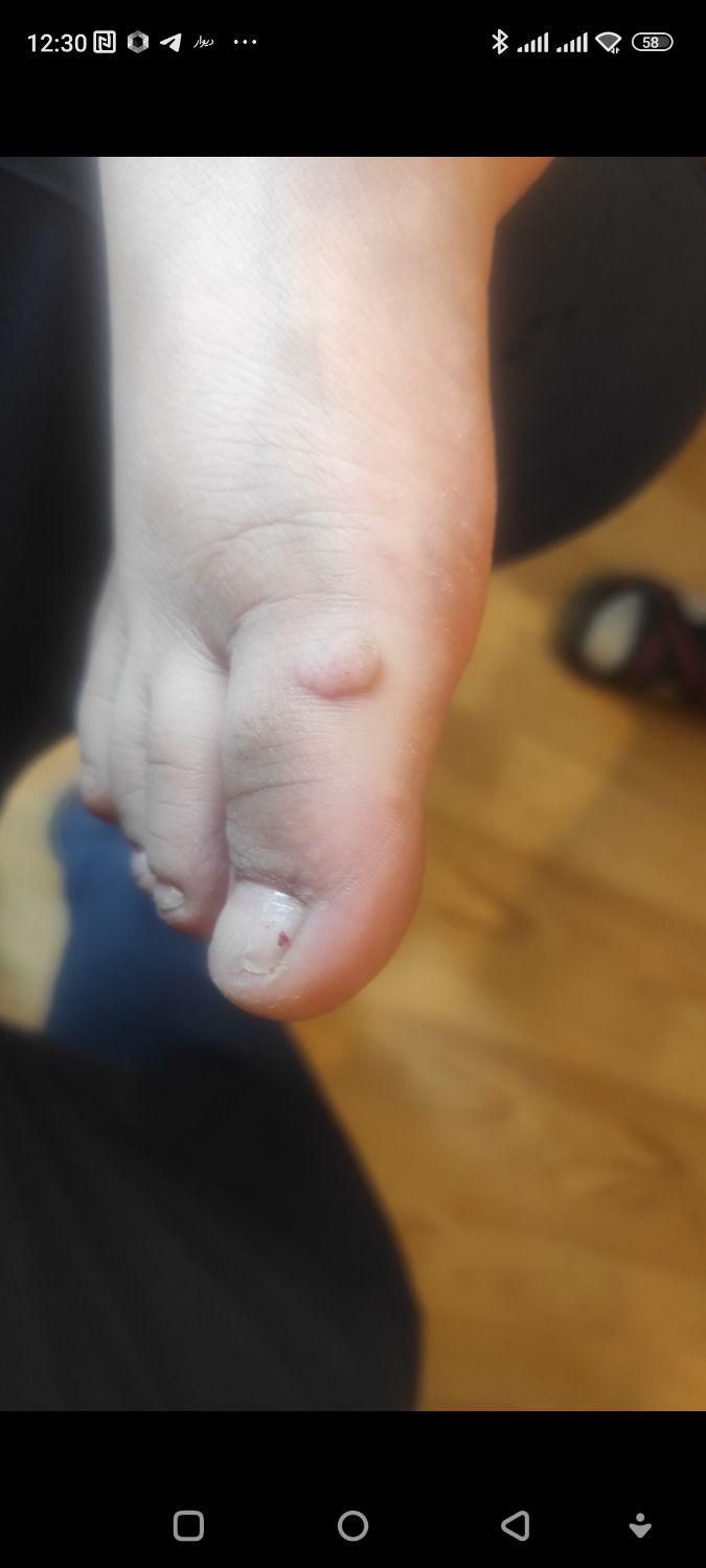 زگیل تناسلی|خدمات آرایشگری و زیبایی|تبریز, |دیوار