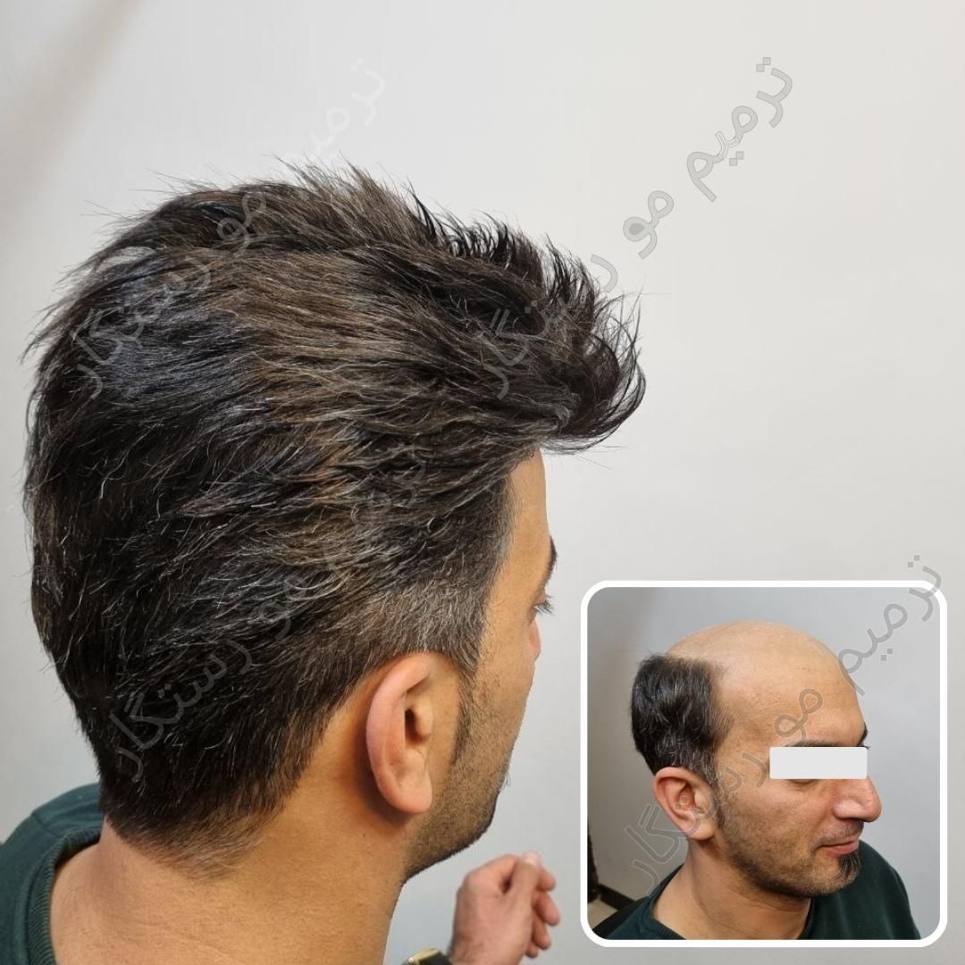 ترمیم مو /پروتز مو  / جایگزین کاشت مو و کلاهگیس|خدمات آرایشگری و زیبایی|اصفهان, آبشار|دیوار