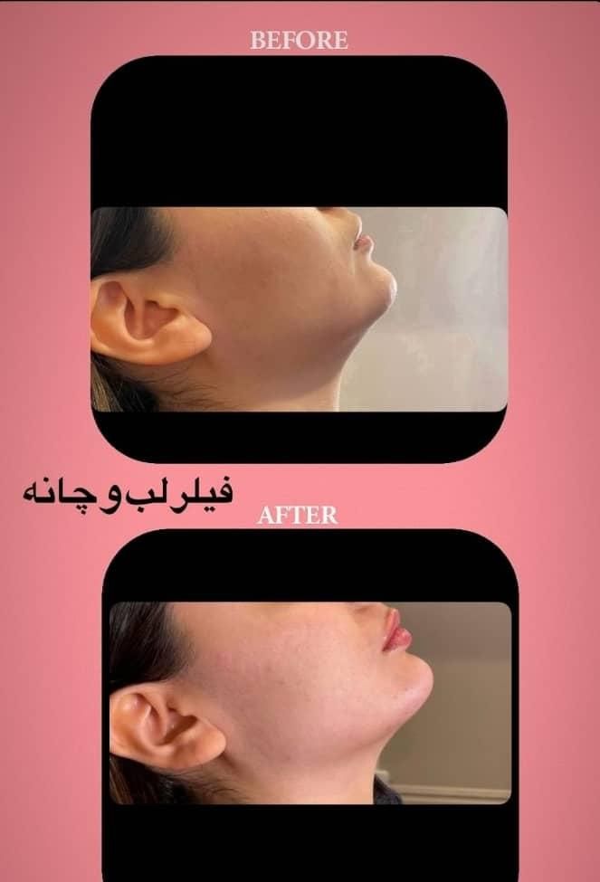 تزریق ژل لب روسی بوتاکس هایفو لیزر فیلر لیفت صورت|خدمات آرایشگری و زیبایی|تهران, ستارخان|دیوار