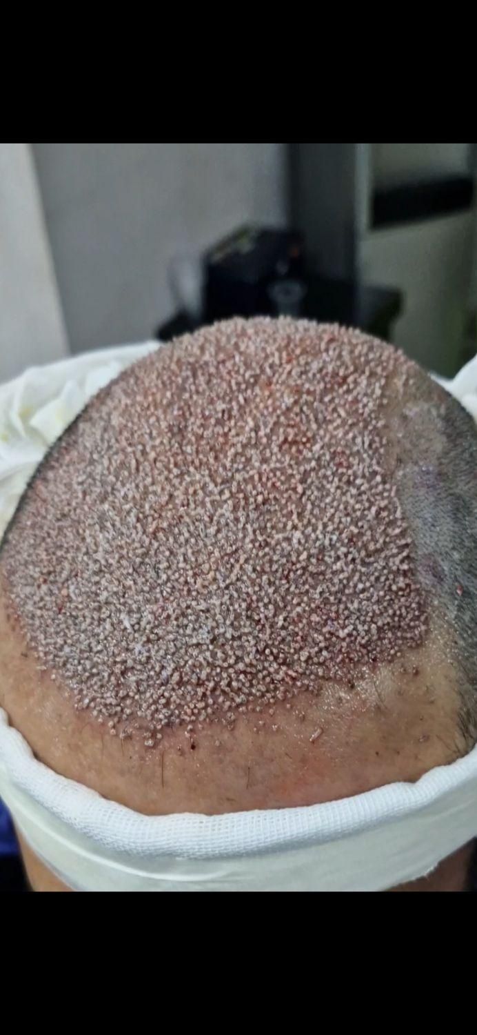 کاشت مو و ابرو با خط رویش طبیعی و پر تراکم|خدمات آرایشگری و زیبایی|تهران, پاسداران|دیوار