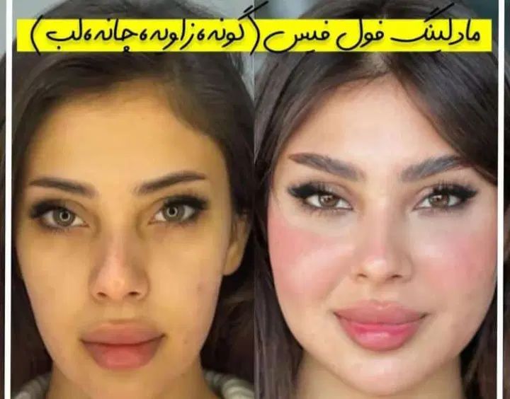 آموزش ژل و بوتاکس/لیفت نخ/لابیاپلاستی/ساکشن غبغب|خدمات آموزشی|تهران, فرمانیه|دیوار