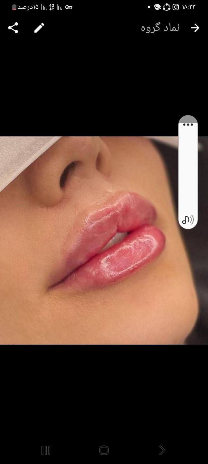 کلینیک تزریق ژل لبMمادلینگMD Codeزاویه بوتاکس لیزر|خدمات آرایشگری و زیبایی|تهران, صادقیه|دیوار