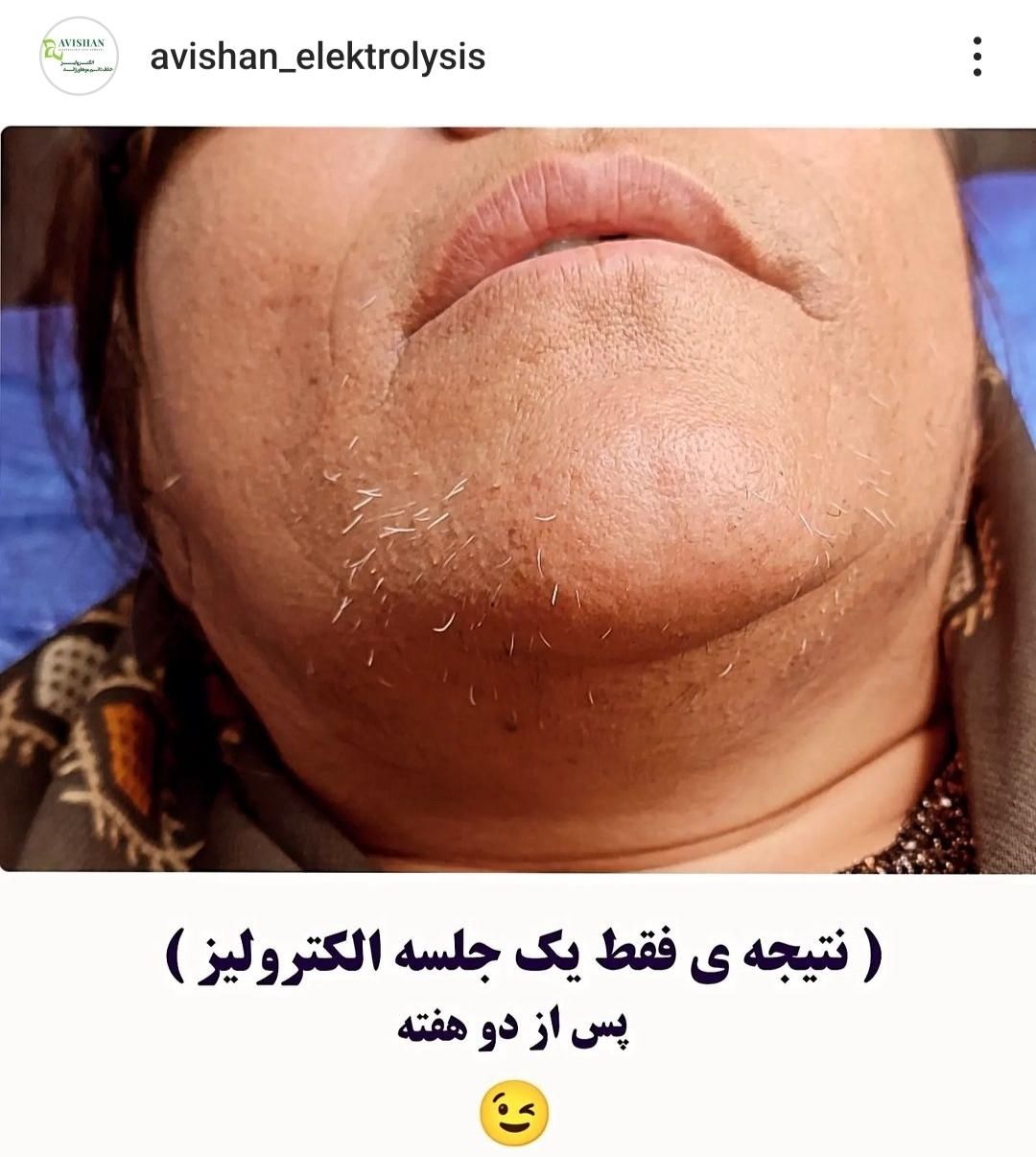 تخفیف الکترولیز،(×لیزر نیست) حذف دائم موهای زائد|خدمات آرایشگری و زیبایی|یاسوج, |دیوار