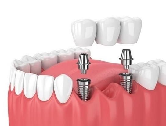 ( ایمپلنت بدون جراحی پانچ از ۶ تومن )|خدمات آرایشگری و زیبایی|اصفهان, سرچشمه|دیوار