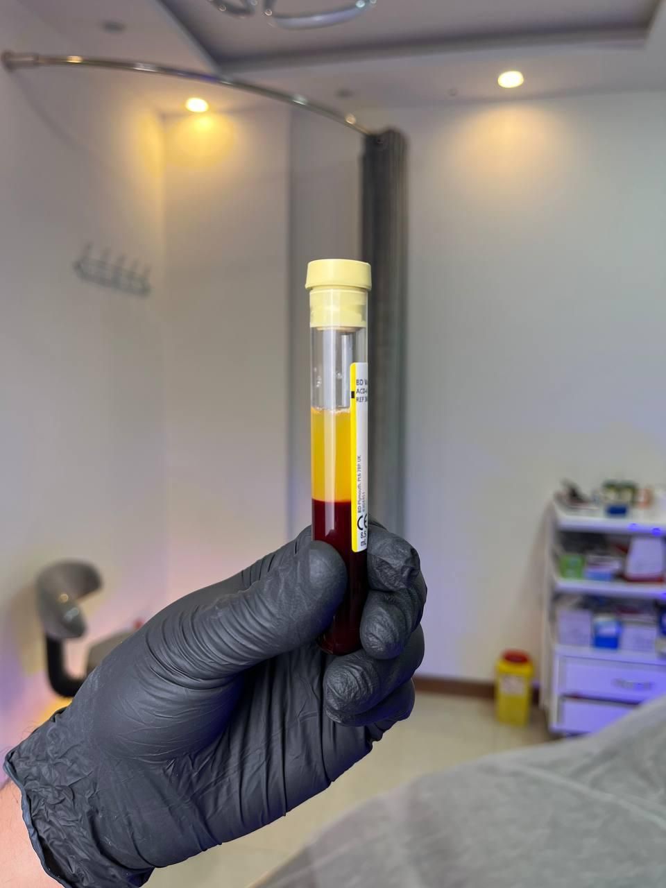 درمان تخصصی ریزش مو در کلینیک زیبایی راویس|خدمات آرایشگری و زیبایی|کاشان, رجایی|دیوار