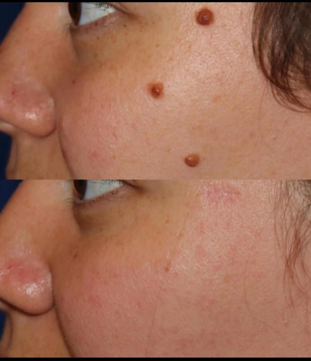 خال برداری کاملا بهداشتی وباوسایل یک بار مصرف|خدمات آرایشگری و زیبایی|قم, امامزاده ابراهیم|دیوار