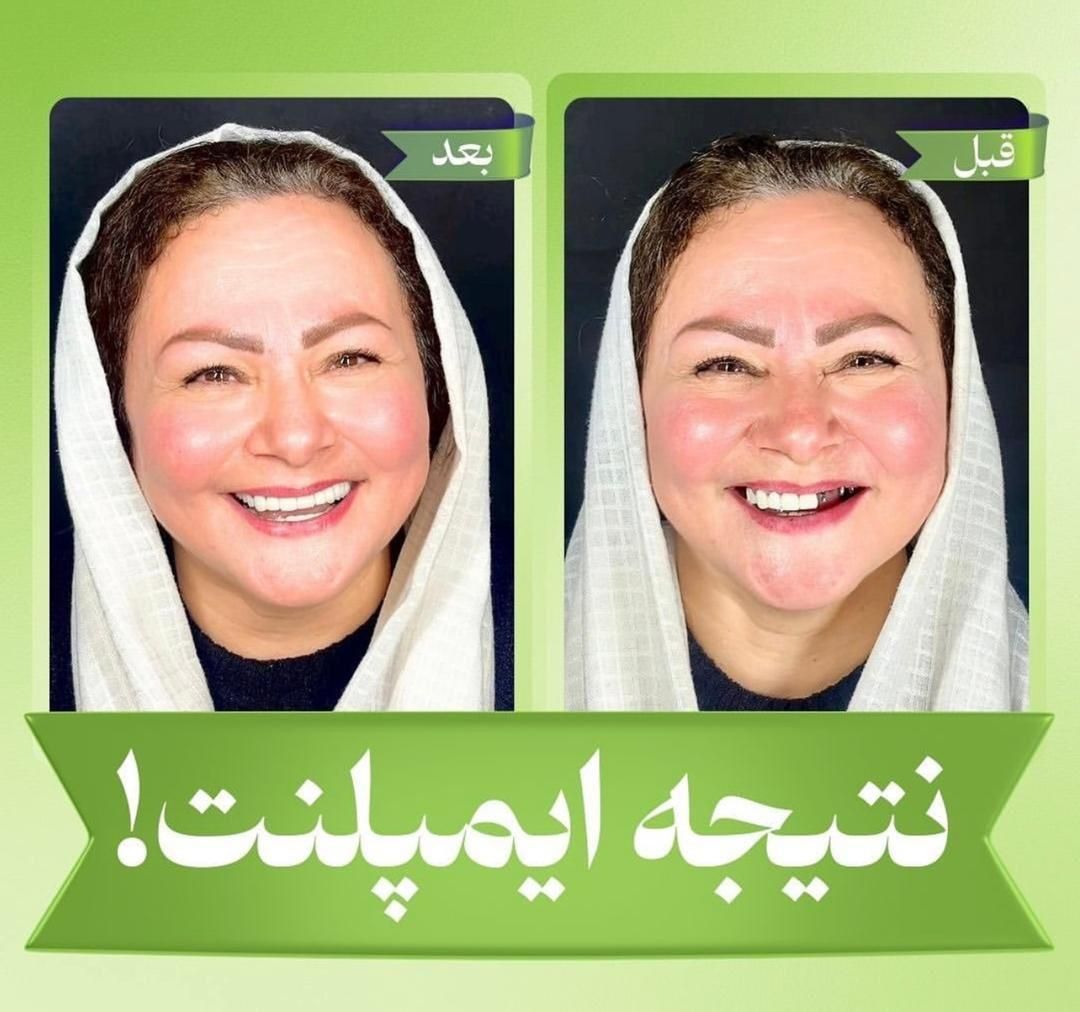 کلینیک تخصصی ایمپلنت دیجیتال5400/فوری/کاشت دندان|خدمات آرایشگری و زیبایی|تهران, پاسداران|دیوار