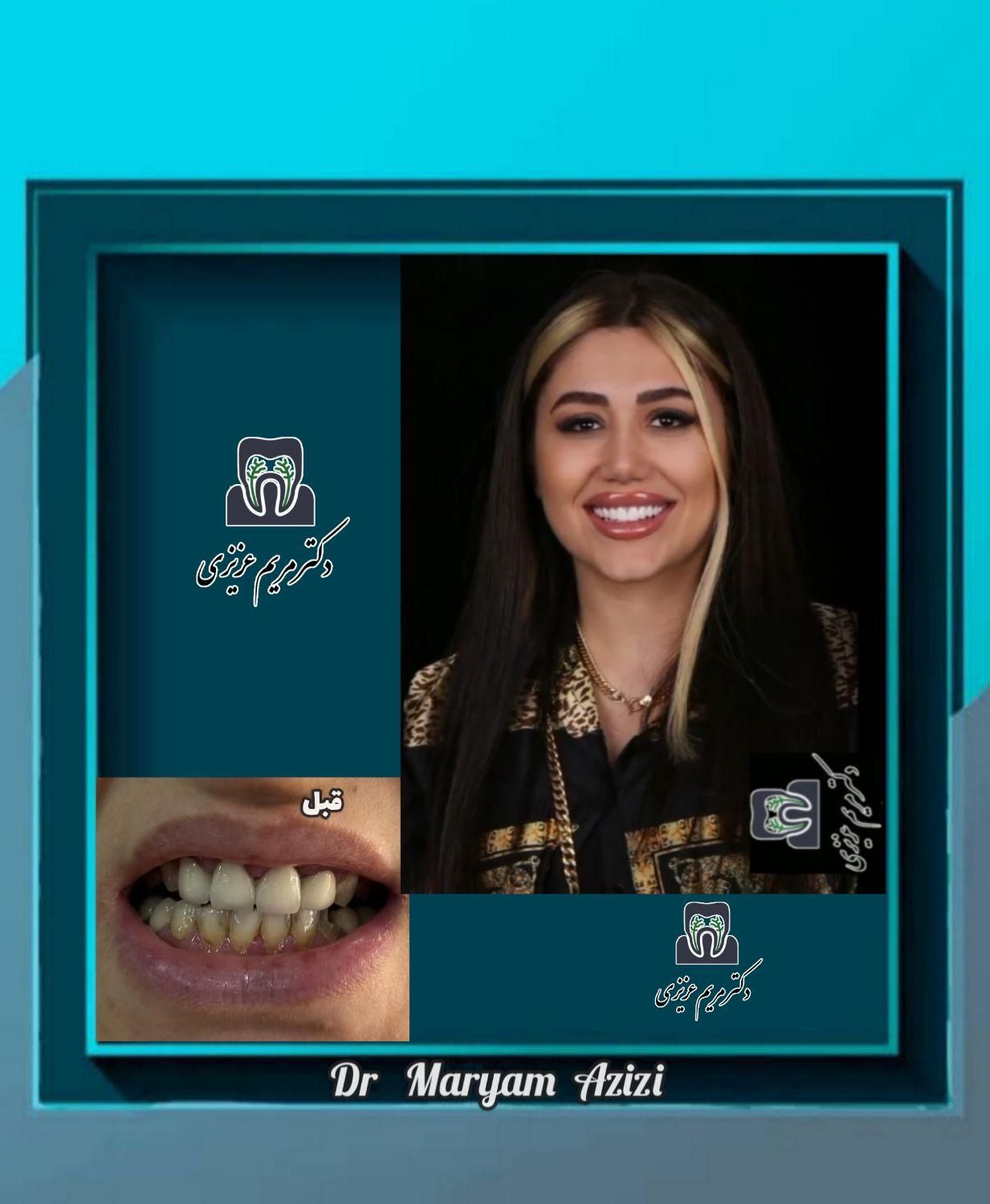 دندانپزشکی ترمیم دندان با مواد کامپوزیت دندان|خدمات آرایشگری و زیبایی|شیراز, معالی‌آباد|دیوار