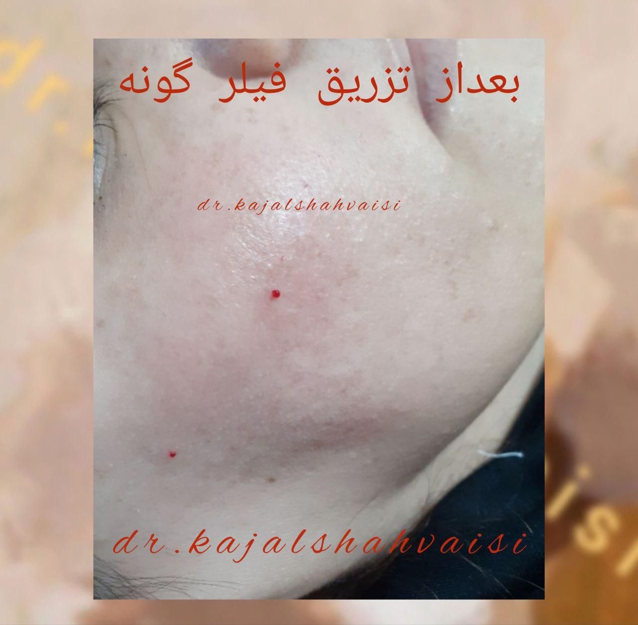 تزریق تخصصی ژل بوتاکس و جوانساز در مطب خانم دکتر|خدمات آرایشگری و زیبایی|سنندج, |دیوار
