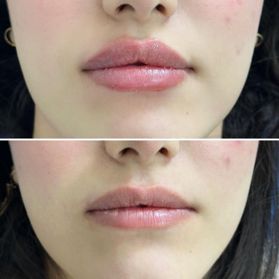 ژل /بوتاکس فیلر لب روسی اموزش بوتاکس آنزیم چربی|خدمات آموزشی|خرم‌آباد, |دیوار