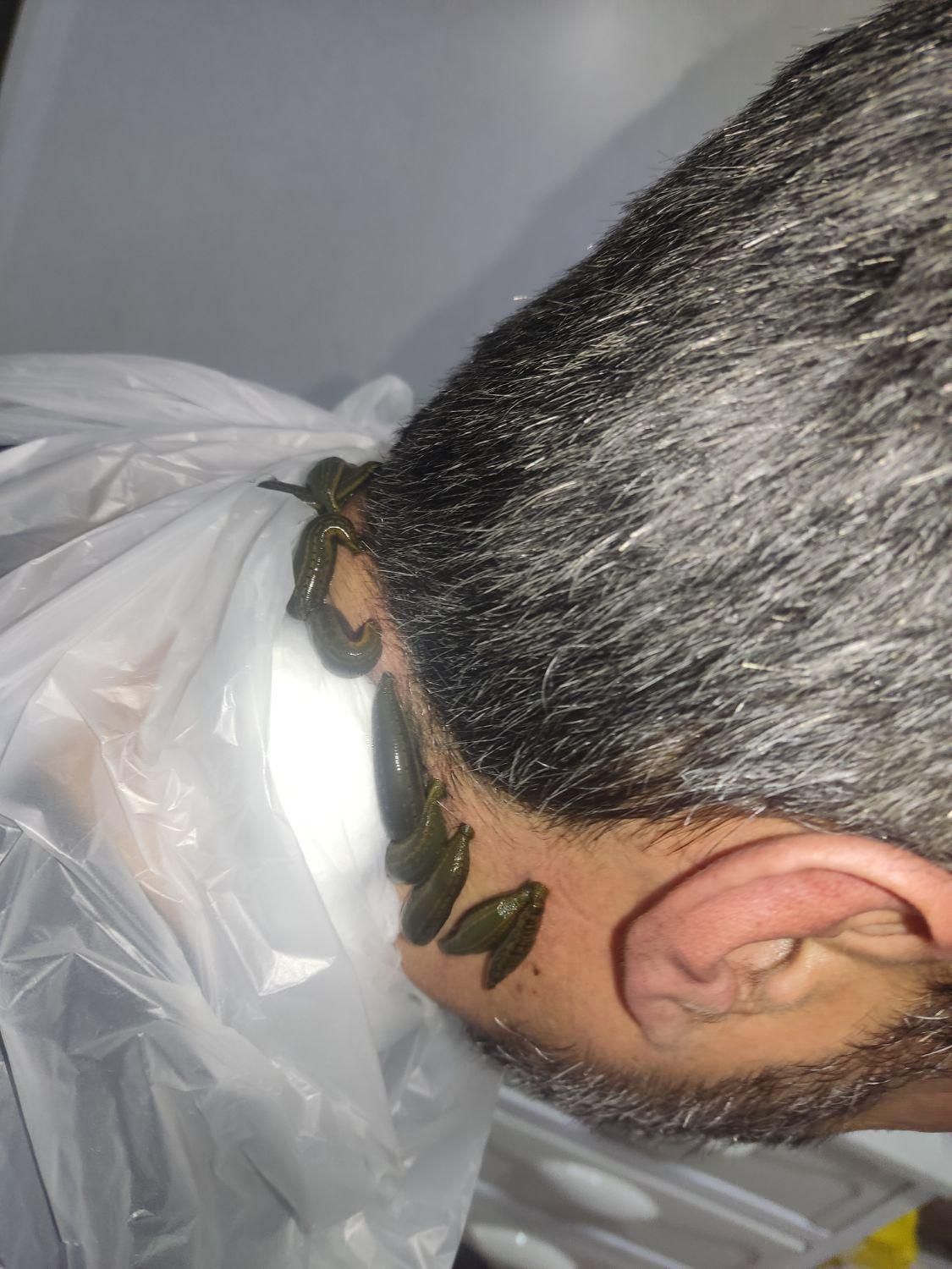 حجامت بختیاری ها،طب سنتی سوزنی ،فصد،زالو prp|خدمات آرایشگری و زیبایی|اصفهان, باغ دریاچه|دیوار