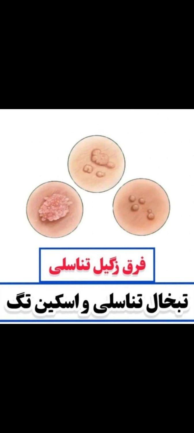 درمان زگیل تناسلی تک جلسه لیزر پیشرفته درمطب متخصص|خدمات آرایشگری و زیبایی|شیراز, قدوسی غربی|دیوار