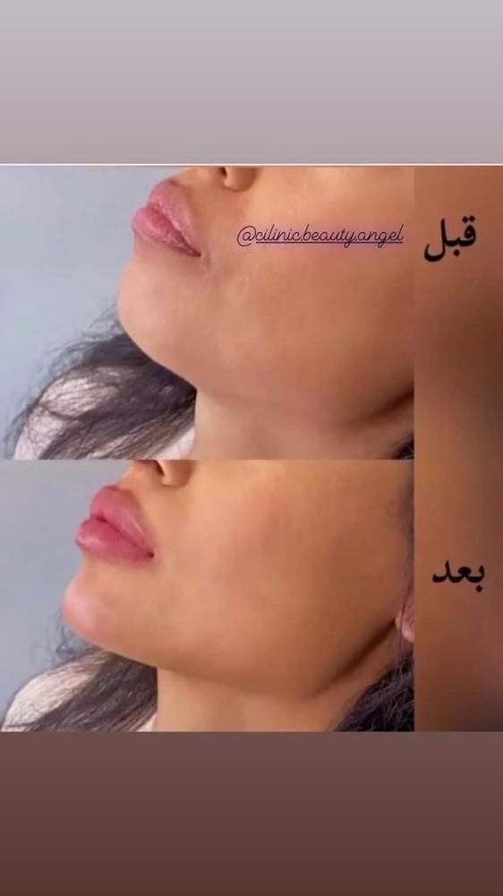 کلینیک تزریق ژل و بوتاکس انزیم پزشک|خدمات آرایشگری و زیبایی|کرج, گوهردشت|دیوار