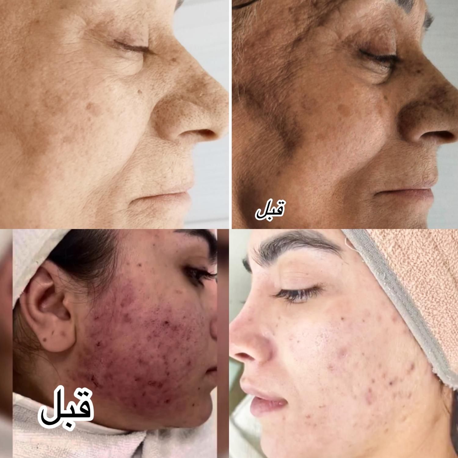 فیشیال تخصصی پوست|خدمات آرایشگری و زیبایی|سبزوار, فرهنگیان|دیوار