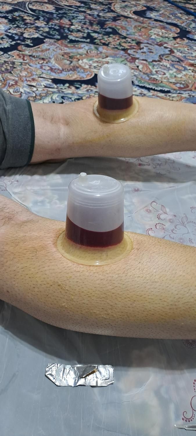حجامت رفع مشکلات کبدی تیرگی پوست خستگی و غلظت خون|خدمات آرایشگری و زیبایی|ایلام, |دیوار