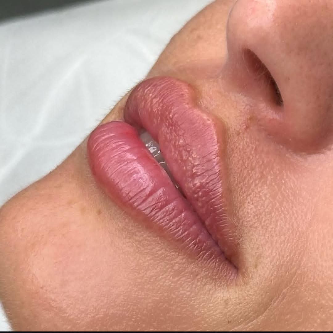 تزریق ژل لب،تزریق ژل گونه ،تزریق ژل چانه، بوتاکس|خدمات آرایشگری و زیبایی|ساری, |دیوار