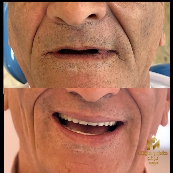 دندانسازی رویال (مرادلو)|خدمات آرایشگری و زیبایی|تهران, قنات‌کوثر|دیوار