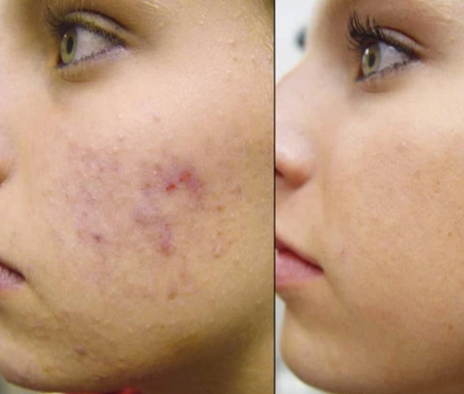 خدمات پاکسازی پوست،میکرونیدیلینگ، پلکسرواسیدتراپی|خدمات آرایشگری و زیبایی|کرج, گوهردشت|دیوار