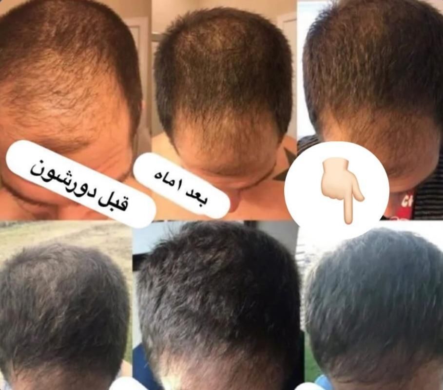 نانوکیت درمان ریزش مو و رویش مجدد|آرایشی، بهداشتی، درمانی|تهران, خرمشهر|دیوار