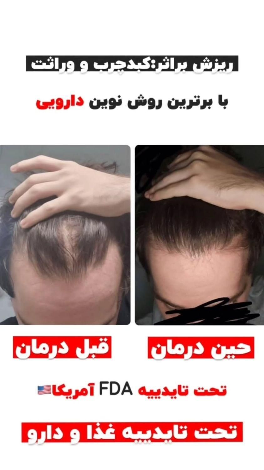نانوکیت درمان ریزش مو و رویش مجدد|آرایشی، بهداشتی، درمانی|تهران, خرمشهر|دیوار