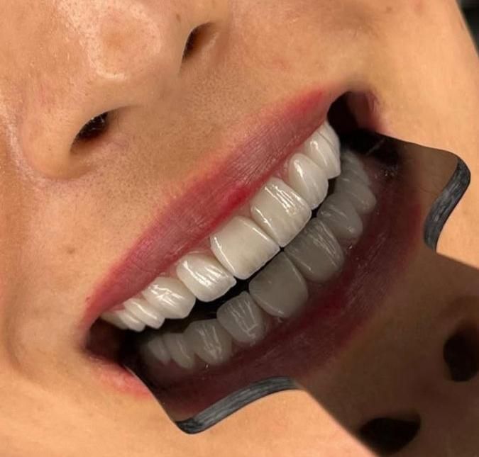 کامپوزیت/لمینت/روکش/پالیش|خدمات آرایشگری و زیبایی|تهران, طرشت|دیوار