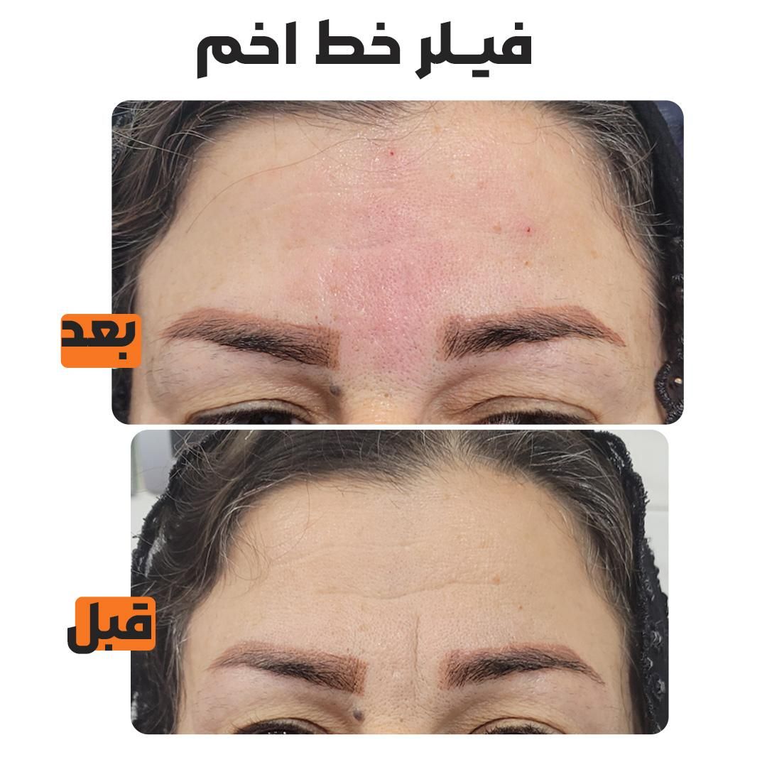 فیلر چروک های صورت|خدمات آرایشگری و زیبایی|شوش, |دیوار