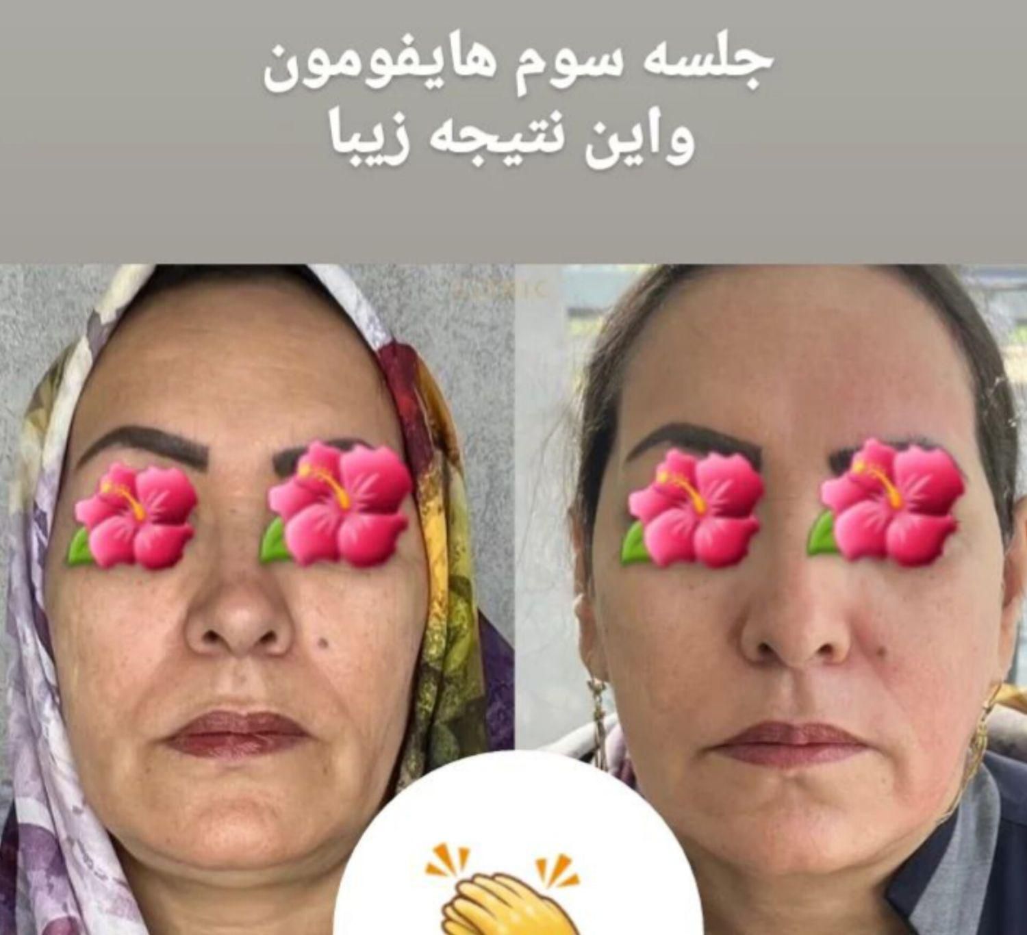 کوچک کردن بینی ورفع پف چشم بدون عمل جراحی|خدمات آرایشگری و زیبایی|مشهد, کوثر|دیوار