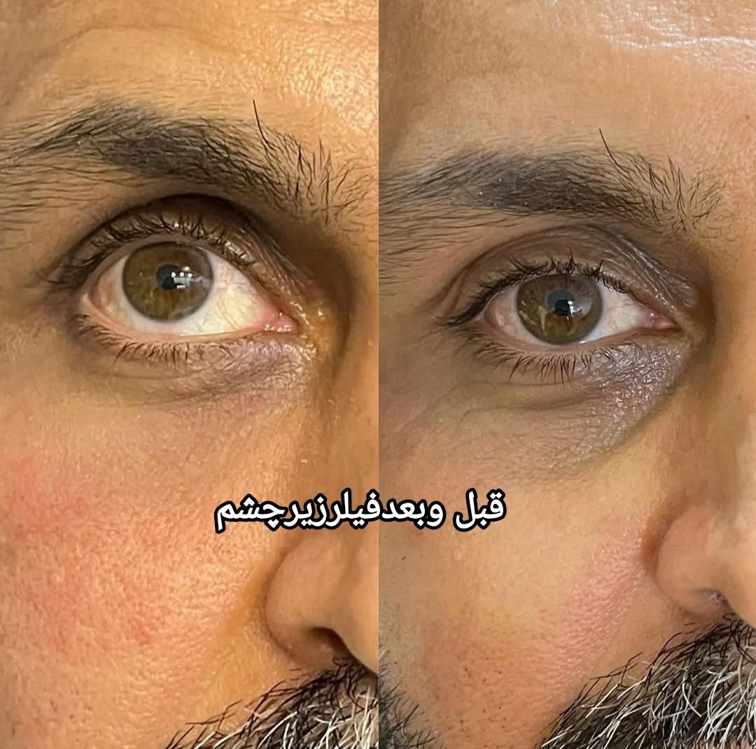 تخفیف ویژه فیلرلب،ژل،انزیم لب،بوتاکس،پی ار پی|خدمات آرایشگری و زیبایی|بندرعباس, |دیوار