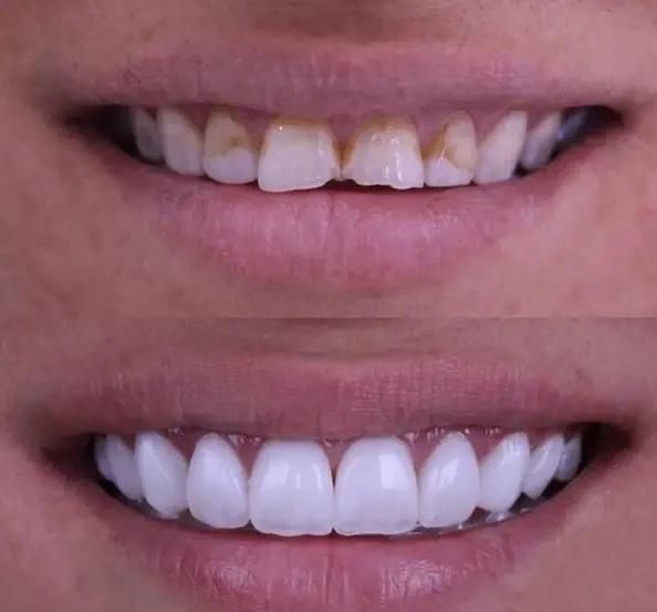 کلینیک تخصصی روکش و روکش ایمپلنت با تضمین کیفیت|خدمات آرایشگری و زیبایی|تبریز, |دیوار