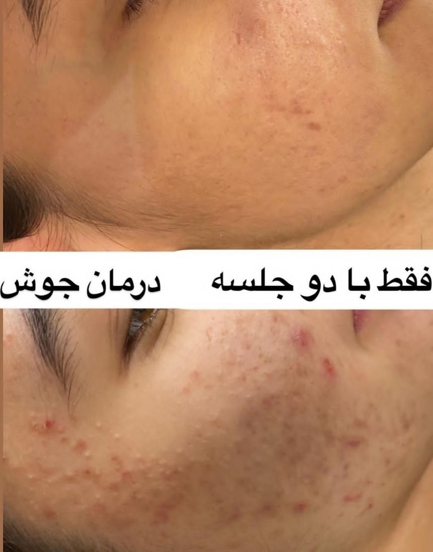 لیزر کیوسوئیچ رفع تیرگی صورت بیکینی و ریمو تاتو|خدمات آرایشگری و زیبایی|ارومیه, |دیوار