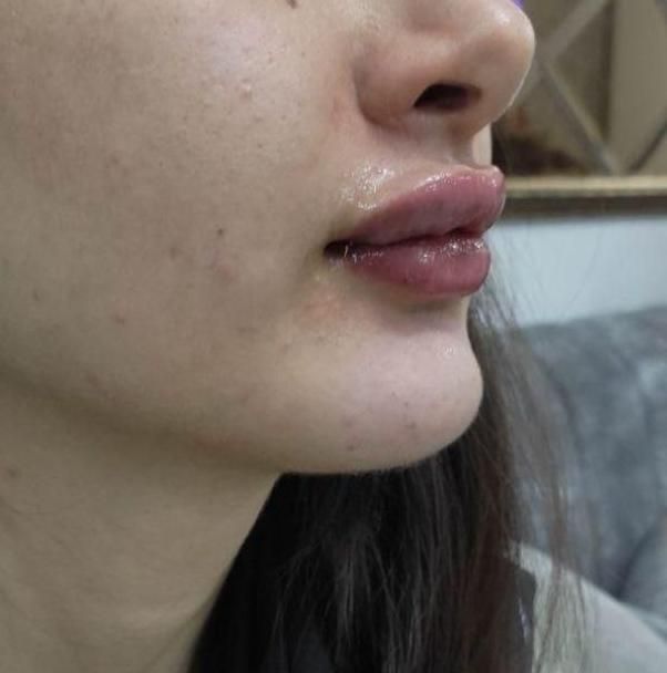 تزریق بوتاکس و ژل در کلینیک(توسط پزشک،)|خدمات آرایشگری و زیبایی|مشهد, هفت تیر (آب و برق)|دیوار