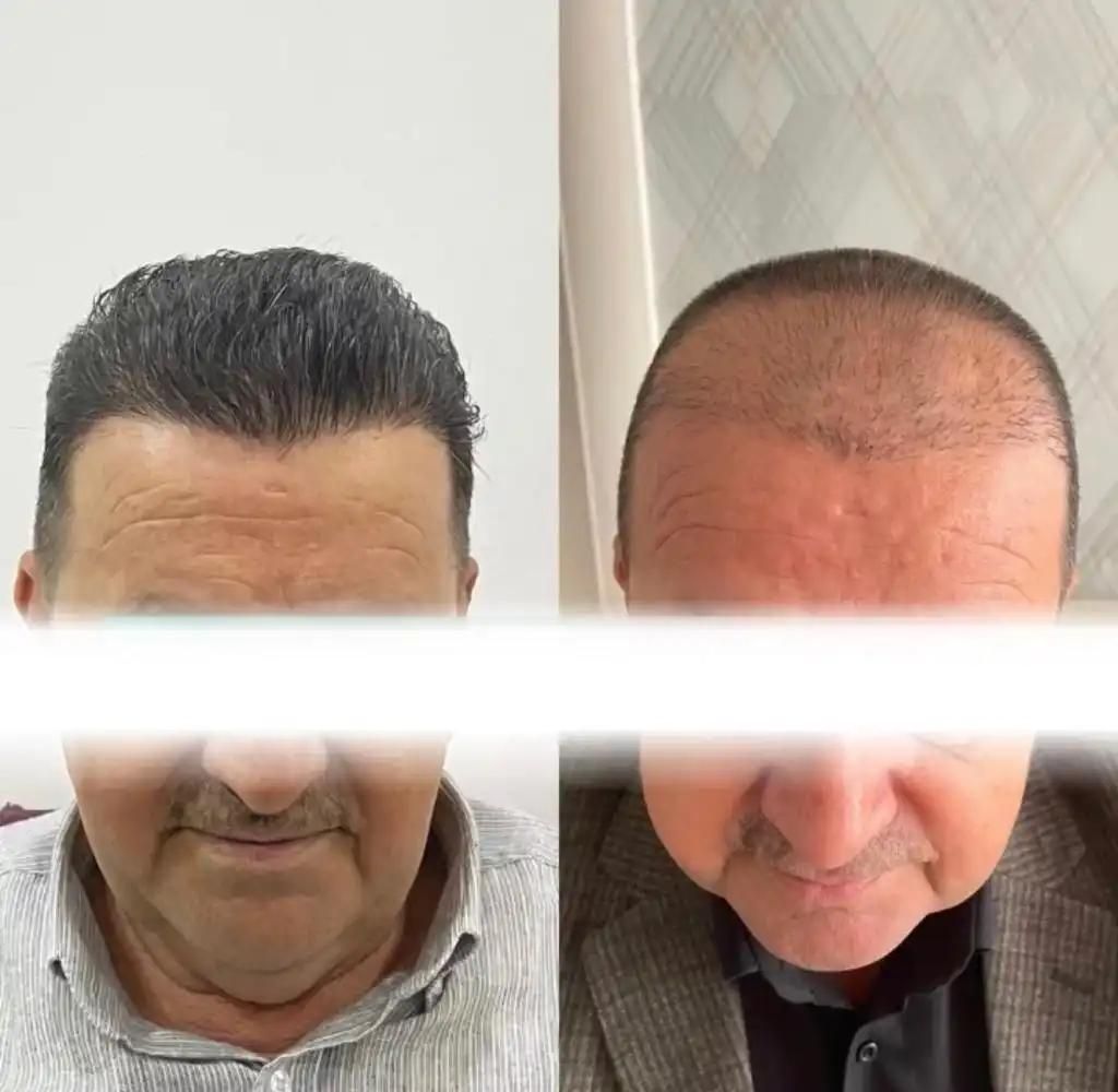 کاشت مو کاشت ابرو کاشت ریش تارکوب|خدمات آرایشگری و زیبایی|هشتگرد, |دیوار