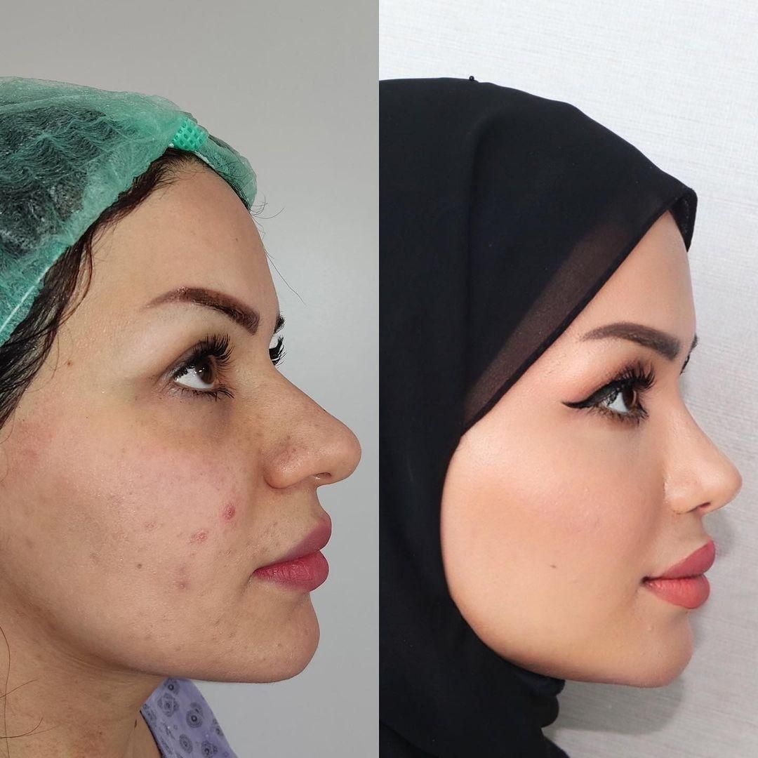 عمل جراحی زیبایی بینی ۲۴ میلیون  رینو بلفارو لیپو|خدمات آرایشگری و زیبایی|تهران, میدان ولیعصر|دیوار