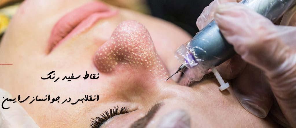 رفع افتادگی پلک و کوچک کردن بینی با پلاسما جت|خدمات آرایشگری و زیبایی|زنجان, |دیوار