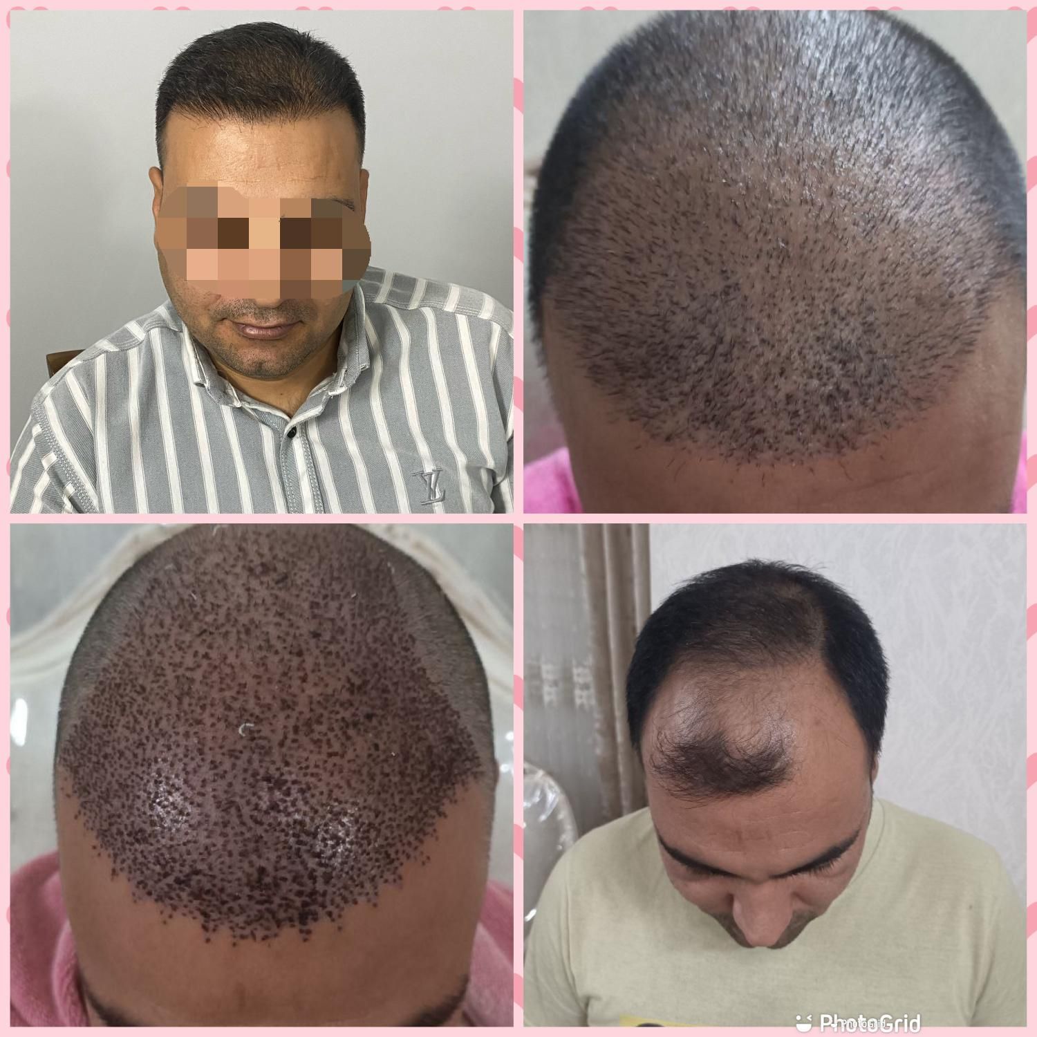 کاشت با ۶ تومان پیش پرداخت|خدمات آرایشگری و زیبایی|مشهد, ملک‌آباد|دیوار