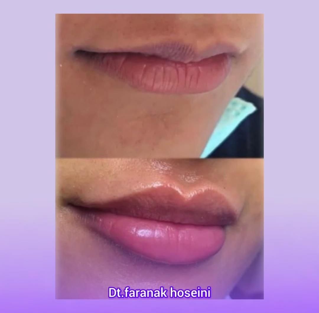 تزریق ژل بوتاکس لیزرمو مزو فیلرلب روسی لیفت صورت|خدمات آرایشگری و زیبایی|تهران, پونک|دیوار
