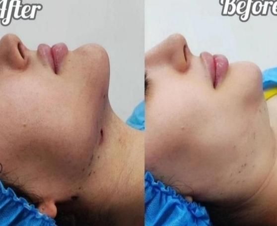 تزریق چربی|خدمات آرایشگری و زیبایی|کرمانشاه, |دیوار