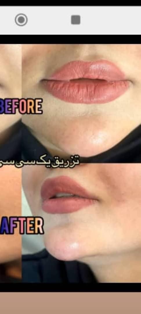 آموزش تخصصی فیلر و بوتاکس خدمات زیبایی|خدمات آموزشی|مشهد, هنرستان|دیوار