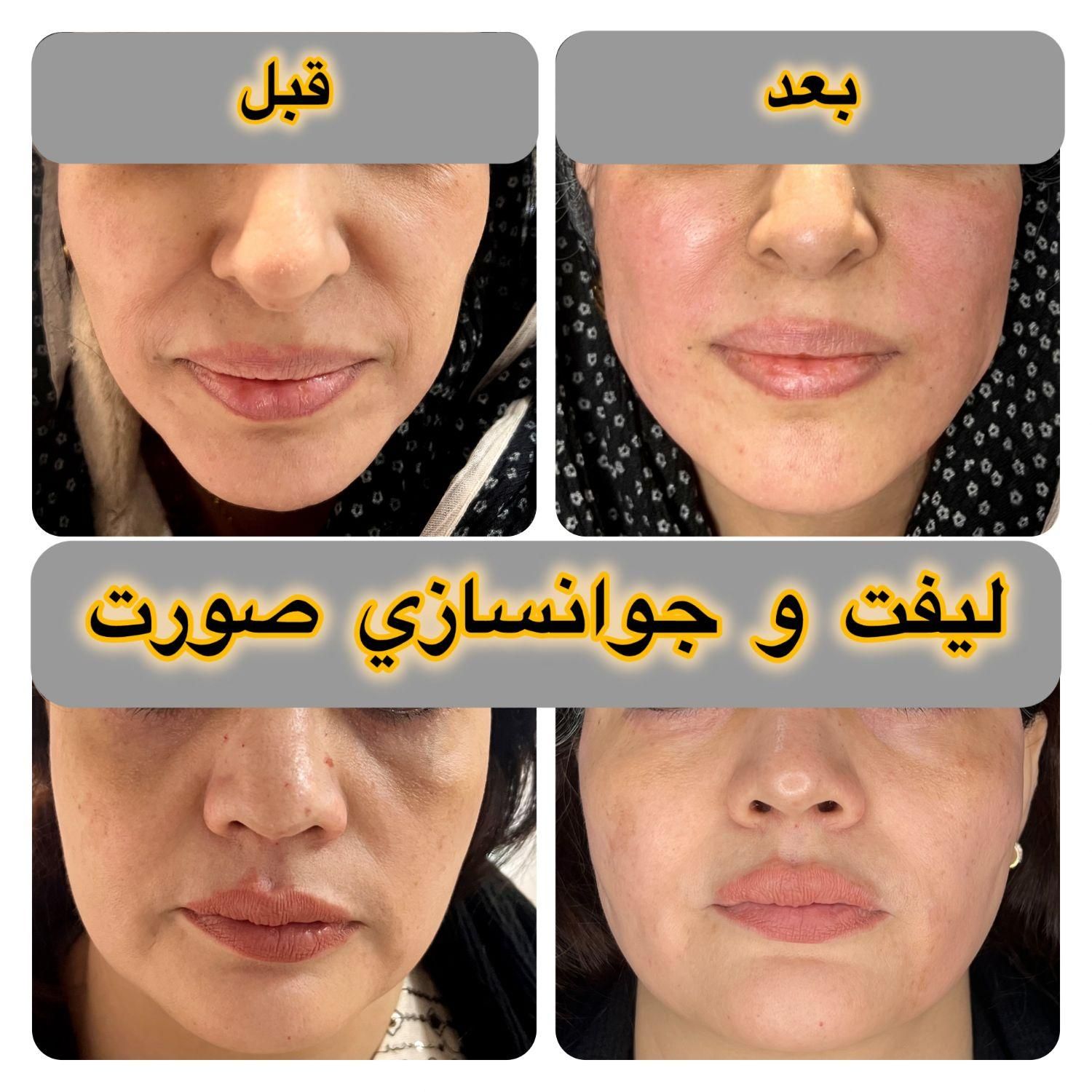 لیفت بایوفیس صورت مزو ژل بوتاکس اصلاح بینی نخ|خدمات آرایشگری و زیبایی|مشهد, احمدآباد|دیوار