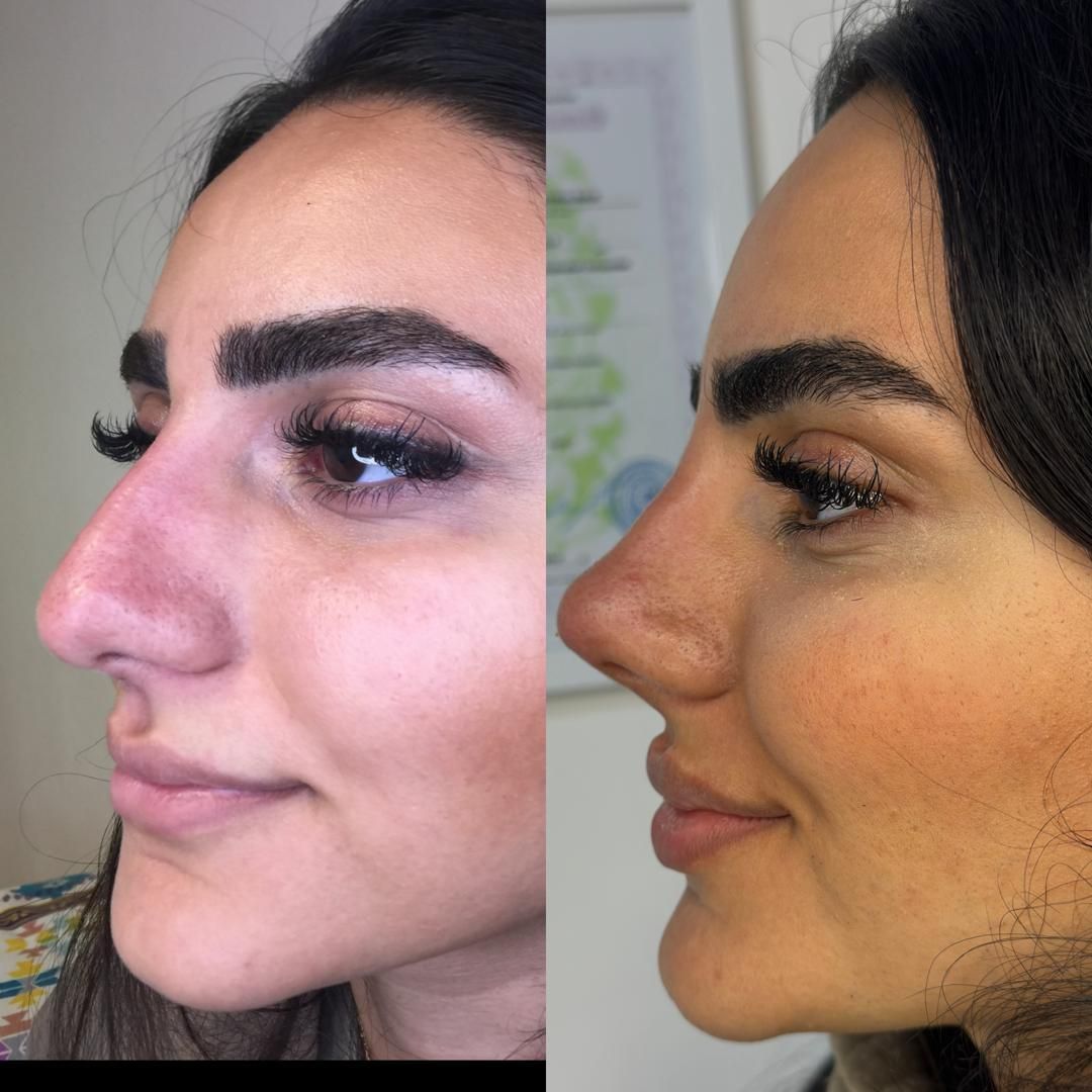 بوتاکس فیلر پی آر پی مزوتراپی زگیل تناسلی|خدمات آرایشگری و زیبایی|تبریز, |دیوار