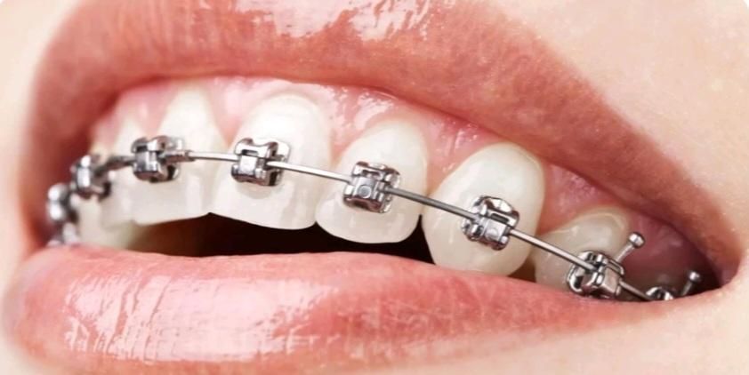 ارتودنسی ثابت ومتحرک|خدمات آرایشگری و زیبایی|شیراز, قصرالدشت|دیوار