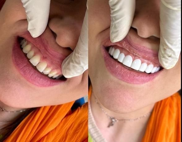 ( ایمپلنت بدون جراحی پانچ از ۶ تومن )|خدمات آرایشگری و زیبایی|اصفهان, سرچشمه|دیوار