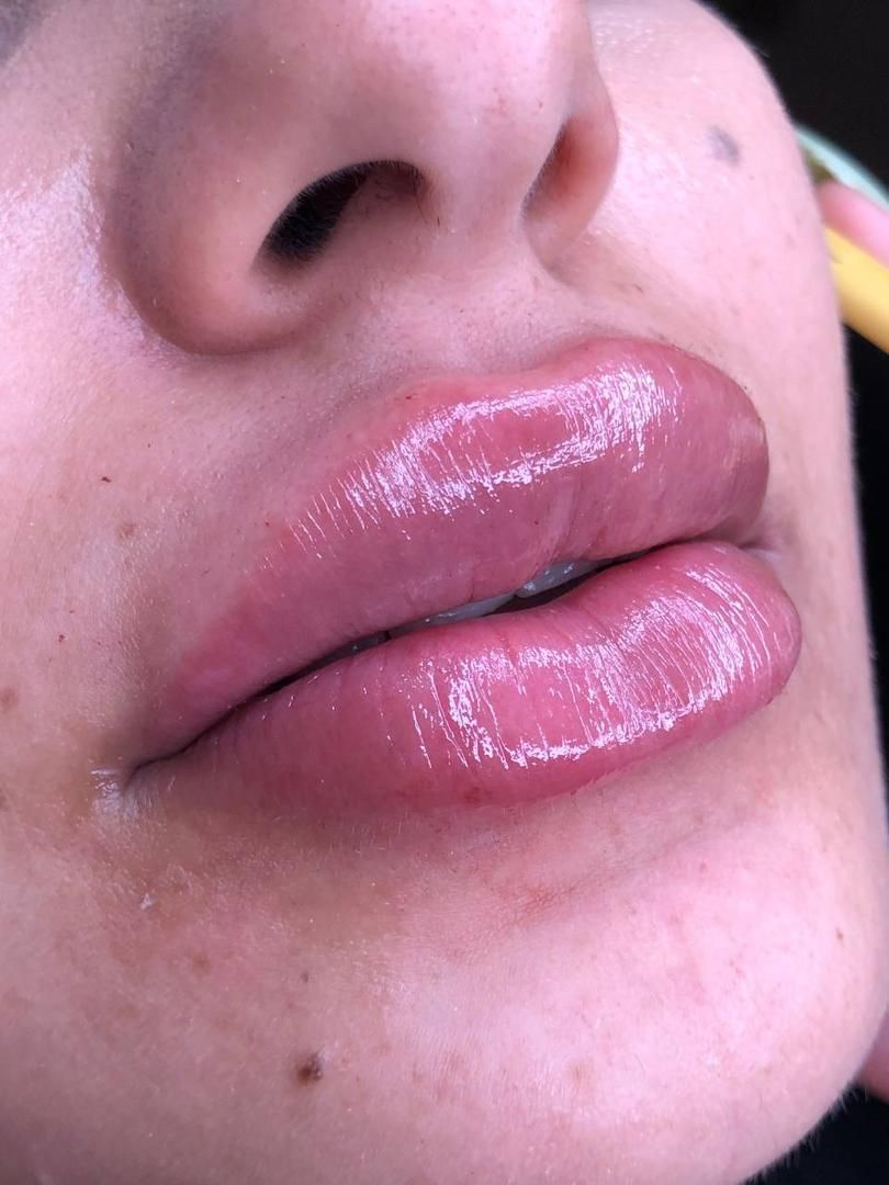 تزریق ژل لب،تزریق ژل گونه ،تزریق ژل چانه، بوتاکس|خدمات آرایشگری و زیبایی|ساری, |دیوار