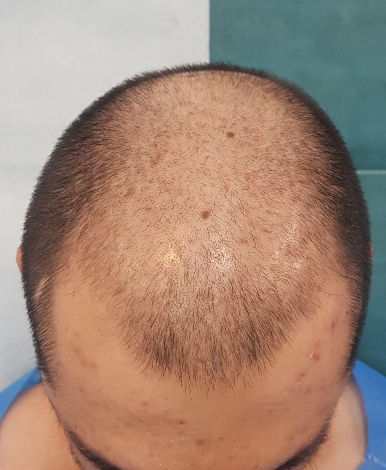 کاشت مو|خدمات آرایشگری و زیبایی|اصفهان, باغ زیار|دیوار