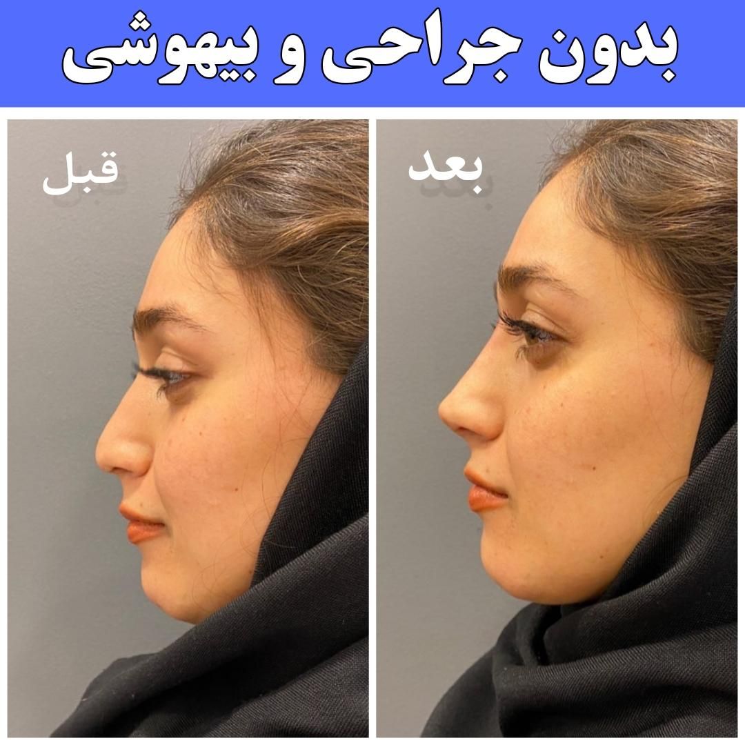 فرم دهی بینی بدون جراحی و بیهوشی رینوپلاستی NOA|خدمات آرایشگری و زیبایی|مشهد, هفت تیر (حافظ)|دیوار