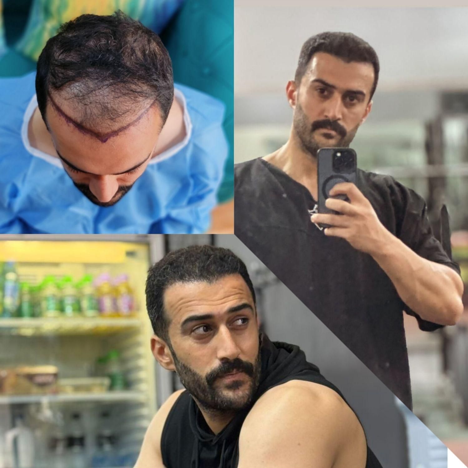 خدمات زیبایی کاشت مو|خدمات آرایشگری و زیبایی|یاسوج, |دیوار