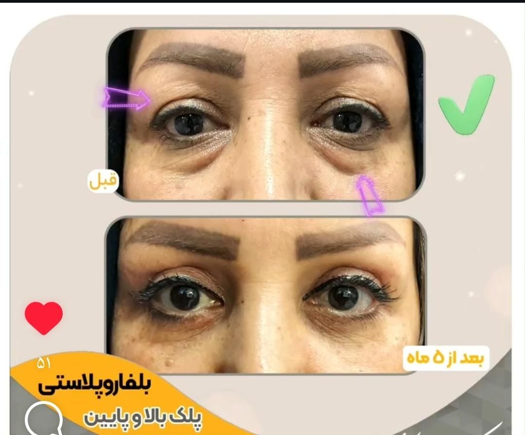 (شوش، شوشتر، اندیمشک) بلفاروپلاستی|خدمات آرایشگری و زیبایی|شوش, |دیوار