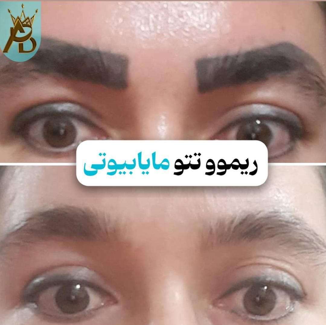 پاک کردن تتو خالکوبی،ریموو تتو ابروـ بدن مایابیوتی|خدمات آرایشگری و زیبایی|یاسوج, |دیوار