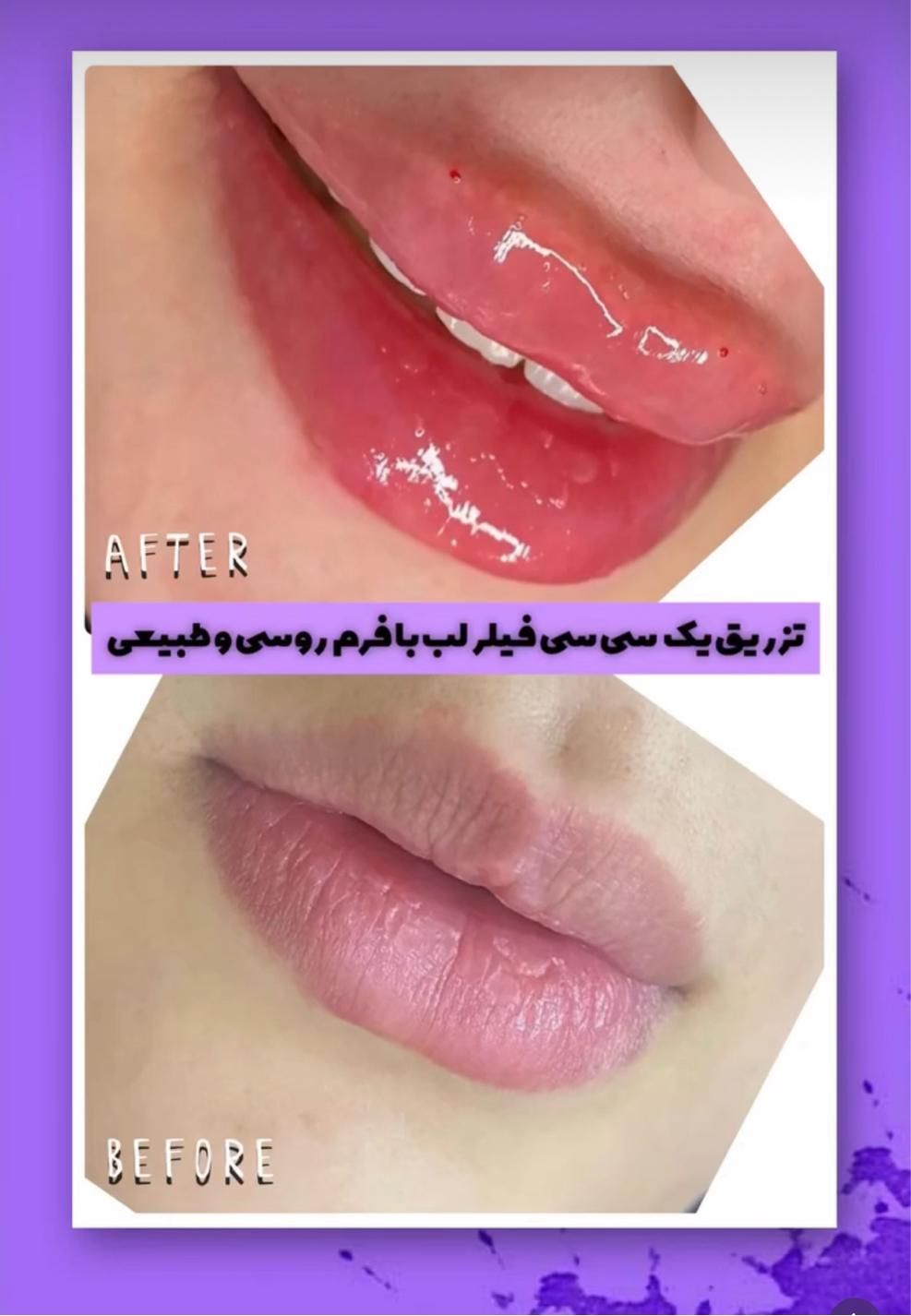 تزریق فیلر ژل بوتاکس هایفو فشیال لیزرکاملا اقساطی|خدمات آرایشگری و زیبایی|اردبیل, |دیوار